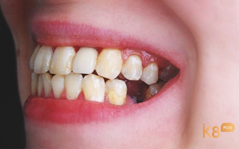 Giấc mơ thấy rụng răng hàm liên quan đến tài chính và cuộc sống của bạn